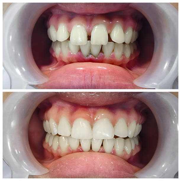 Dental Inlays and Onlays